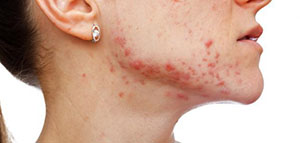 الحبوب تحت الجلد و علاج الحبوب تحت الجلد صورة: الحبوب تحت الجلد و علاج الحبوب تحت الجلد