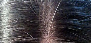 تدليك فروة الرأس و اتباع نظام غذائي و فيتامينات لتقوية فروة الرأس صورة: تدليك فروة الرأس و اتباع نظام غذائي و فيتامينات لتقوية فروة الرأس