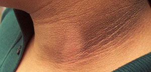 صورة: سواد الرقبة