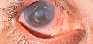 التهاب القزحية و أعراض التهاب القزحية صورة: التهاب القزحية و أعراض التهاب القزحية