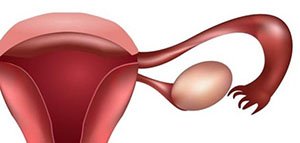 كيس الماء على المبيض و أنواع أكياس المبايض صورة: كيس الماء على المبيض و أنواع أكياس المبايض