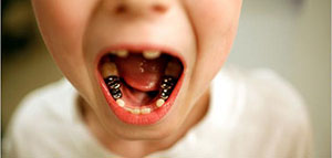 أين يتم تآكل الأسنان و أنواع تآكل الأسنان صورة: أين يتم تآكل الأسنان و أنواع تآكل الأسنان