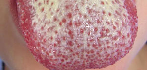 ما هي فطريات اللسان و أعراض فطريات اللسان صورة: ما هي فطريات اللسان و أعراض فطريات اللسان