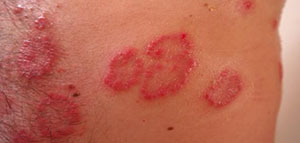 صورة: آثار بق الفراش على الجلد و مضاعفات بق الفراش