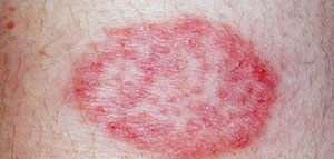 صورة: ظهور الحبوب الحمراء في الجسم و فيديو ظهور حبوب حمراء صغيرة في الجسم