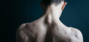 حبوب الظهر و وصفات طبيعية للتخلص من حبوب الظهر صورة: حبوب الظهر و وصفات طبيعية للتخلص من حبوب الظهر