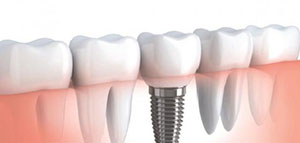 صورة: طب الأسنان و زراعة الأسنان و مميزات زراعة الأسنان