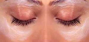 صورة: الهالات السوداء و علاج الهالات السوداء حول العينين