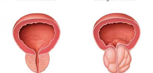 البروستاتا و أمراض البروستاتا و علاج أمراض البروستاتا صورة: البروستاتا و أمراض البروستاتا و علاج أمراض البروستاتا