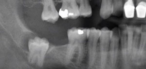 ضرس العقل و أسباب عدم ظهور أضراس العقل صورة: ضرس العقل و أسباب عدم ظهور أضراس العقل
