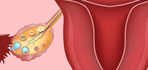 علاج ضعف البويضات و أسباب ضعف البويضات صورة: علاج ضعف البويضات و أسباب ضعف البويضات