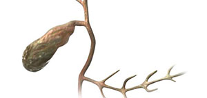 صورة: التهاب المرارة و علاج التهاب المرارة