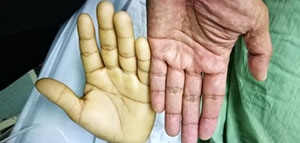 أعراض فقر الدم العامة و أعراض فقر الدم حسب النوع صورة: أعراض فقر الدم العامة و أعراض فقر الدم حسب النوع