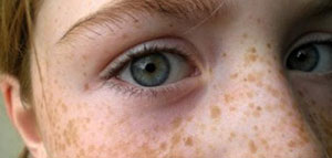 النمش و وصفات طبيعية لإزالة النمش و كريمات التخلص من النمش صورة: النمش و وصفات طبيعية لإزالة النمش و كريمات التخلص من النمش