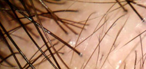 بصيلات الشعر و أسباب ضعف نمو بصيلات الشعر صورة: بصيلات الشعر و أسباب ضعف نمو بصيلات الشعر