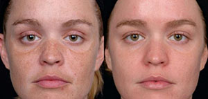 تقشير البشرة بالليزر و حالات التقشير بالليزر صورة: تقشير البشرة بالليزر و حالات التقشير بالليزر