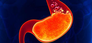 صورة: حموضة المعدة و علاج حموضة المعدة و نصائح لعلاج حموضة المعدة