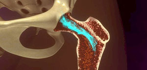 موقع نخاع العظم في الجسم و أنواع نخاع العظم صورة: موقع نخاع العظم في الجسم و أنواع نخاع العظم