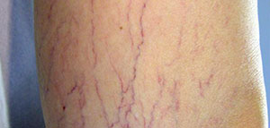 دوالي الساقين و أعراض دوالي الساقين و أسباب الإصابة بدوالي الساقين صورة: دوالي الساقين و أعراض دوالي الساقين و أسباب الإصابة بدوالي الساقين