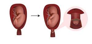 صورة: ما هو ربط الرحم و أهمية ربط الرحم و هل ربط الرحم مناسب للجميع