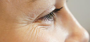 صورة: التجاعيد و طرق إزالة تجاعيد تحت العين