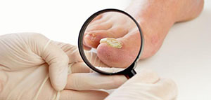 علاج فطريات القدم و نصائح للتغلب على فطريات القدم صورة: علاج فطريات القدم و نصائح للتغلب على فطريات القدم