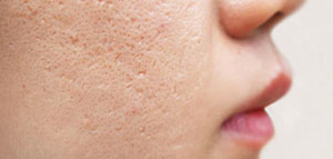 صورة: ثقوب الوجه و التقشير الكيميائي و الكريمات الموضعية