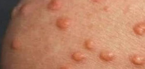 مرض داء اللؤلؤ صورة: مرض داء اللؤلؤ