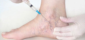 صورة: كيف يتم علاج الدوالي عند النساء و ماذا عن التدابير المنزلية للتخلص من الدوالي