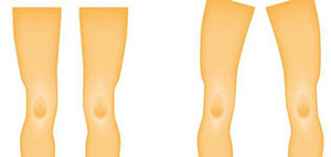 صورة: مقدمة تعرف بالمرض وانتشاره و فيديو عن علاج مرض الكساح