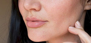 صورة: نصائح وإرشادات لتخفيف جفاف الجلد و علاج جفاف الجلد طبيا