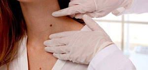 صورة: ا لتعريف بالزائد الجلدية ومواصفاتها و أسباب ظهور الزوائد الجلدية