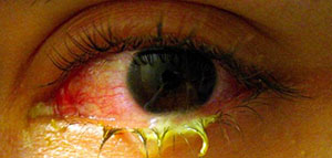 صورة: الوقاية من مرض الرمد و ملعومات حول مرض الرمد