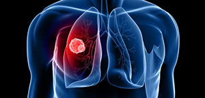 صورة: المرحلة الأخيرة لسرطان الرئة و أعراض المرحلة الأخيرة لسرطان الرئة