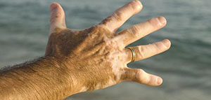 صورة: مواضيع اخرى عن مرض البهاق و تلخيص الموضوع