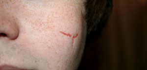 صورة: طرق طبية لإزالة الندوب من الوجه و طرق طبيعية لإزالة الندوب من الوجه