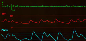 صورة: تعريف الضغط الشرياني الوسطي و حساب الضغط الشرياني الوسطي