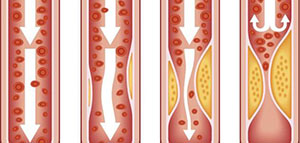 صورة: تصلب الشرايين و أعراض تصلب الشرايين و أسباب تصلب الشرايين