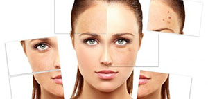 صورة: حب الشباب و أسباب ظهور حب الشباب و إخفاء حب الشباب عن طريق المكياج