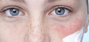 صورة: احمرار الوجه المفاجئ