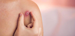 صورة: نصائح للتعامل مع الدمل في المنزل و علاج الدمل طبيا