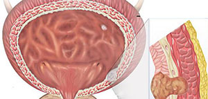 صورة: التهاب المثانة و أعراض التهاب المثانة
