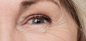 صورة: التجاعيد تحت العينين و نصائح لإزالة التجاعيد تحت العينين