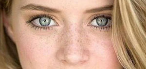 صورة: النمش و أسباب ظهور النمش في الوجه والجسم