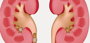صورة: الأعراض الأولية لمرض الفشل الكلوي و أنواع الفشل الكلوي