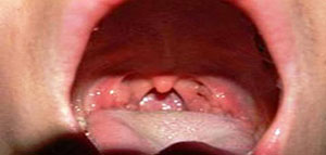 صورة: لسان المزمار و اضطرابات تحدث في لسان المزمار