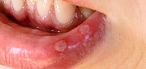 صورة: التهاب الشفاه من الخارج و أنواع التهاب الشفاه من الخارج وأسبابها