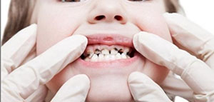 صورة: ما هي أسباب تسوس الأسنان و ما هي العوامل التي تزيد من احتمالية الإصابة بتسوس