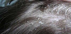 صورة: مشكلة القشرة و أسباب ظهور القشرة و وصفات طبيعية لتخفيف القشرة