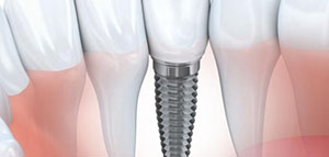 صورة: زراعة الأسنان و كيف تتم زراعة الأسنان